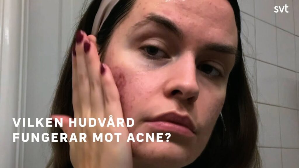 Acne och finnar – hjälper hudvårdsprodukter? | SVT